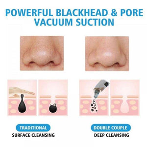Electric Vacuum Blackhead Remover Acne Black Spot Extractor Pore Cleaner